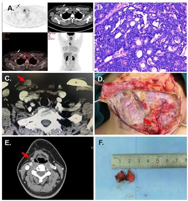 Subcutaneous implantation after endoscopic and traditional thyroid surgery: a retrospective case report